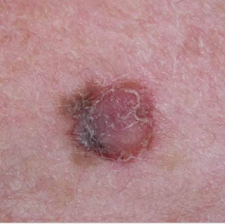 melanoma image courtesy of Dr. Jonathan Bowling