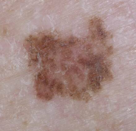 melanoma image courtesy of Dr. Jonathan Bowling