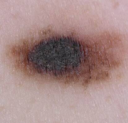 melanoma image courtesy of Dr. Jonathan Bowling
