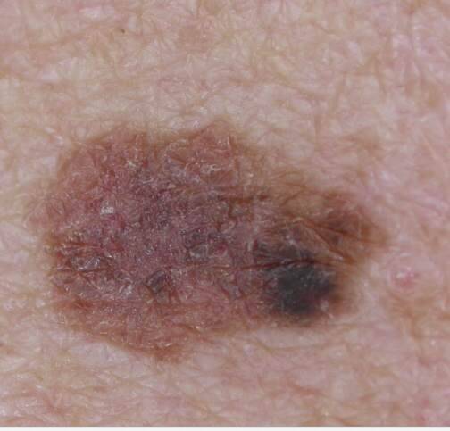 melanoma image courtesy of Dr. Jonathan Bowling