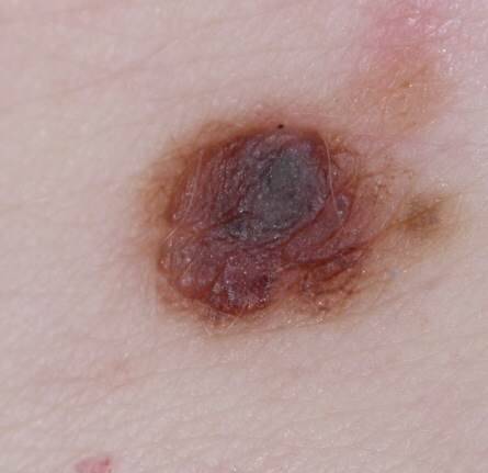 melanoma image courtesy of Dr. Jonathan Bowling