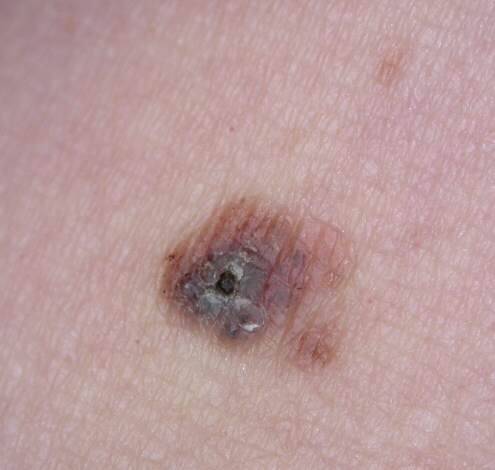 melanoma image courtesy of Dr. Jonathan Bowling